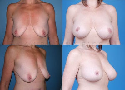Breast Lift with Augmentation Gallery - Patient 10131259 - Image 1
