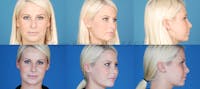 Revision Rhinoplasty Gallery - Patient 10131359 - Image 1