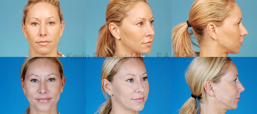 Revision Rhinoplasty Before & After Gallery - Patient 10131360 - Image 1