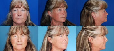 Revision Rhinoplasty Before & After Gallery - Patient 10131361 - Image 1