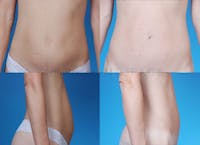 Mini Tummy Tuck Before & After Gallery - Patient 10131886 - Image 1