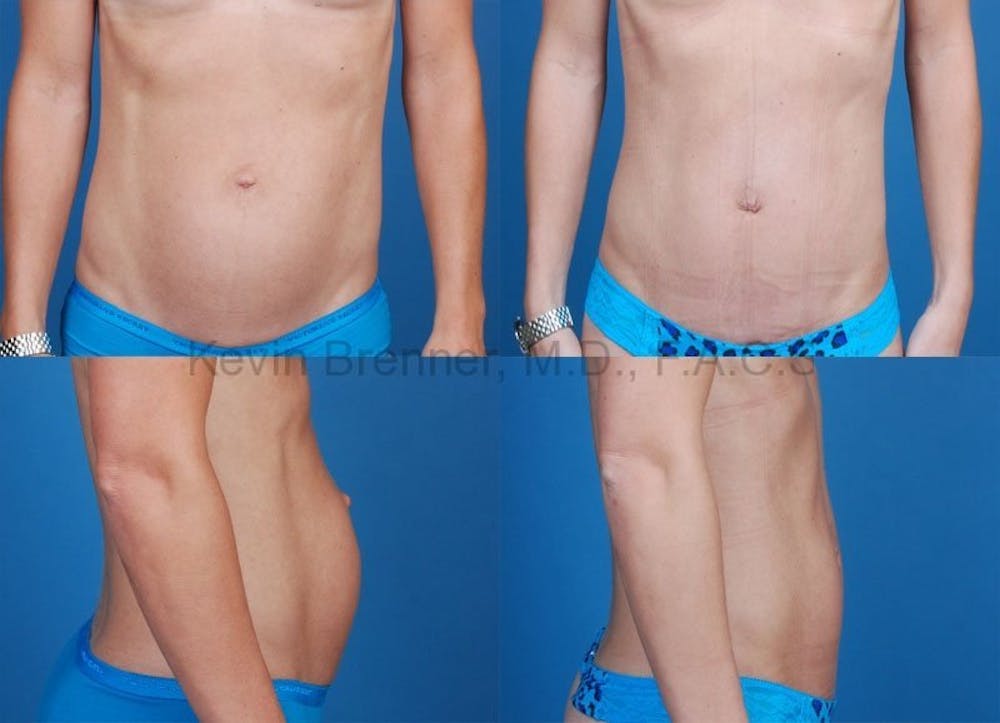 Mini Tummy Tuck Before & After Gallery - Patient 10131887 - Image 1