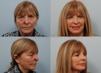 Skin Cancer Reconstruction Before & After Gallery - Patient 10132130 - Image 1