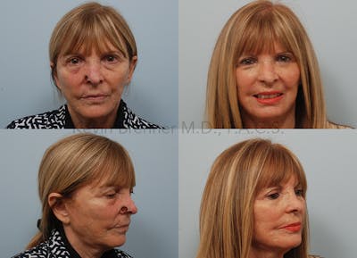 Skin Cancer Reconstruction Before & After Gallery - Patient 10132130 - Image 1