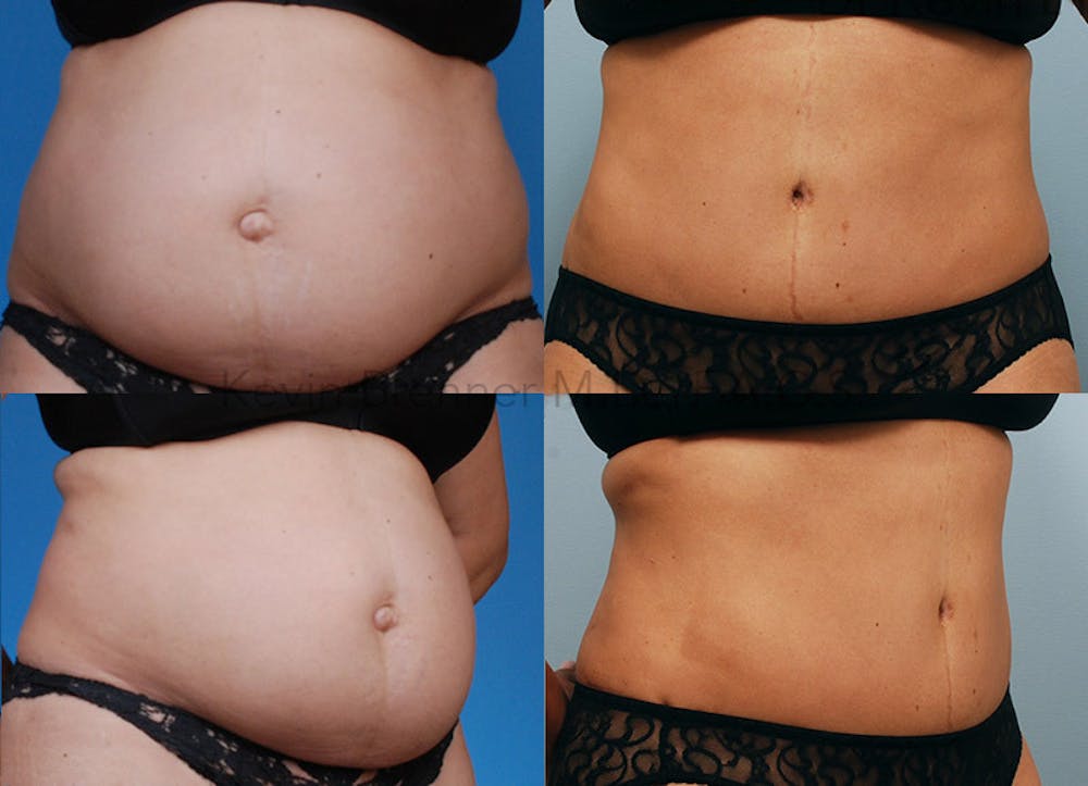 Tummy Tuck Before & After Gallery - Patient 1482406 - Image 1
