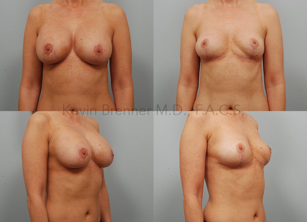 Breast Implant Removal Before & After Gallery - Patient 11258302 - Image 1