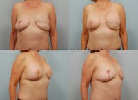 Breast Reconstruction Before & After Gallery - Patient 11258394 - Image 1