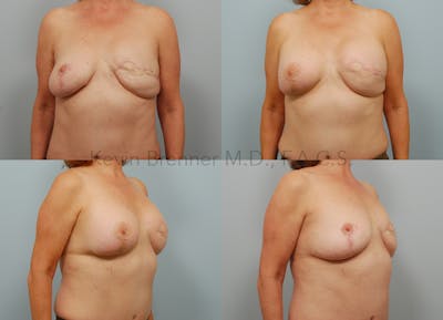 Breast Reconstruction Before & After Gallery - Patient 11258394 - Image 1