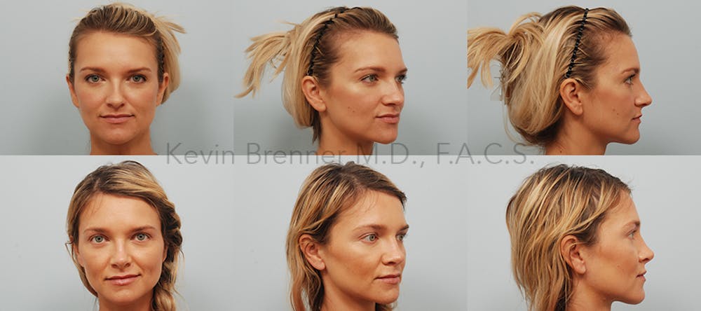 Rhinoplasty Before & After Gallery - Patient 11258837 - Image 1