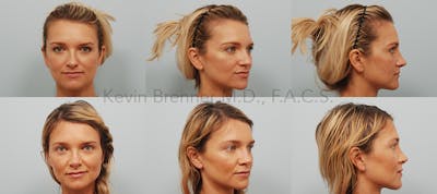 Rhinoplasty Before & After Gallery - Patient 11258837 - Image 1
