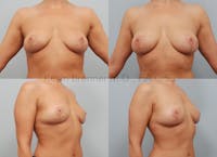 Fat Transfer Post Explant Before & After Gallery - Patient 11258879 - Image 1