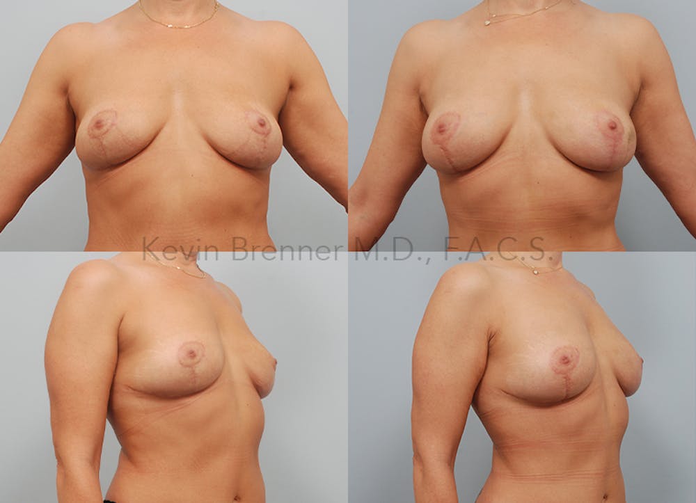 Fat Transfer Post Explant Before & After Gallery - Patient 11258879 - Image 1