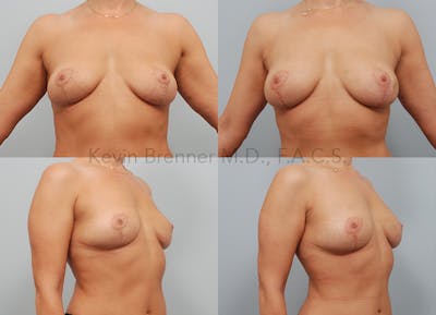 Fat Transfer Post Explant Gallery - Patient 11258879 - Image 1