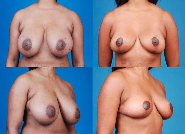 Before and after breast reduction by Dr. Brenner.