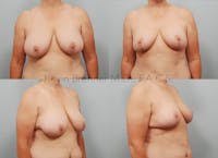Breast Reduction Before & After Gallery - Patient 11904739 - Image 1