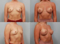 Breast Augmentation Before & After Gallery - Patient 11904741 - Image 1