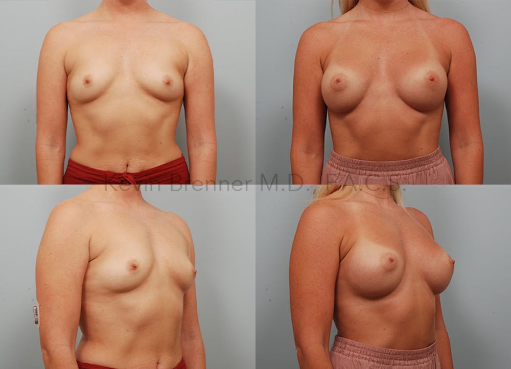 Breast Augmentation Before & After Gallery - Patient 11904741 - Image 1