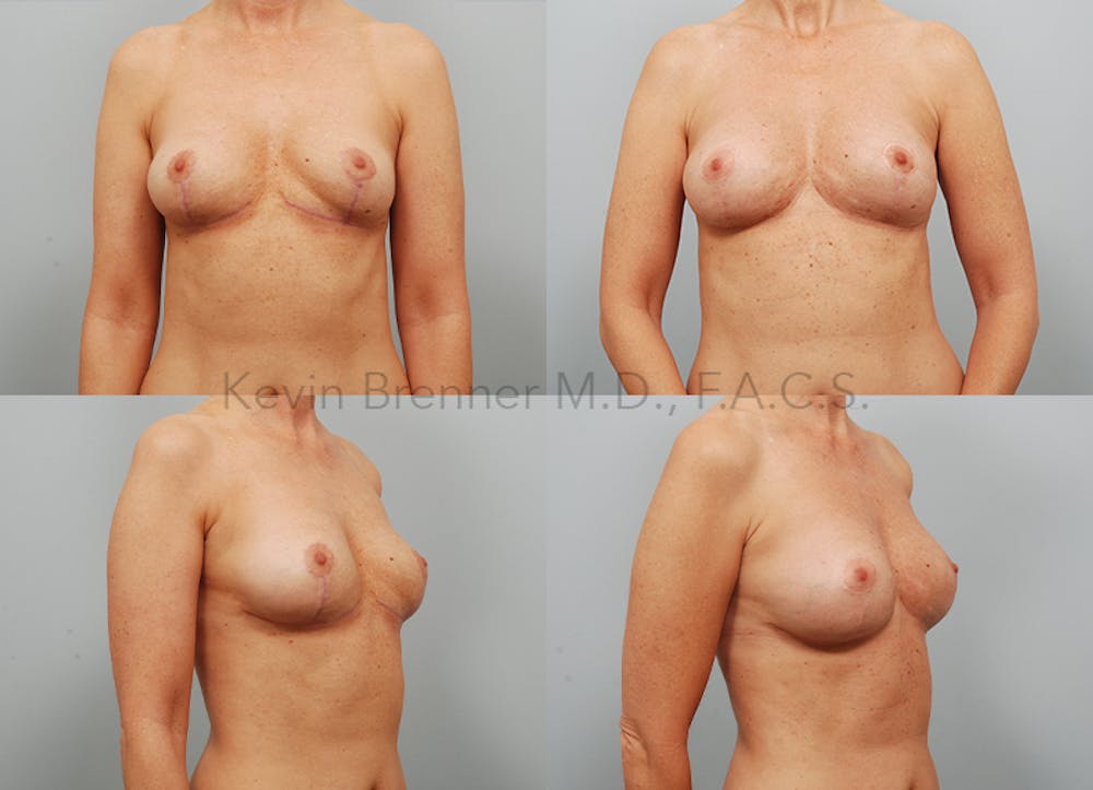 Fat Transfer Post Explant Before & After Gallery - Patient 11258304 - Image 1