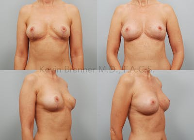 Fat Transfer Post Explant Before & After Gallery - Patient 11258304 - Image 1