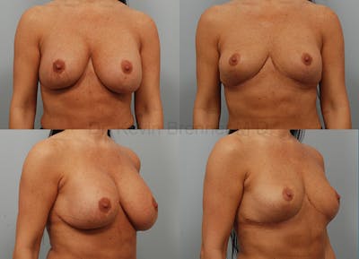 Breast Lift Before & After Gallery - Patient 291225 - Image 1