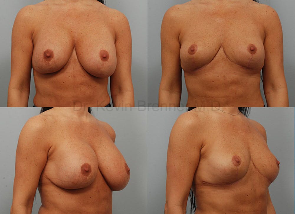 Breast Implant Removal Before & After Gallery - Patient 1482384 - Image 1