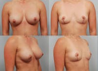 Breast Implant Removal Before & After Gallery - Patient 1482377 - Image 1