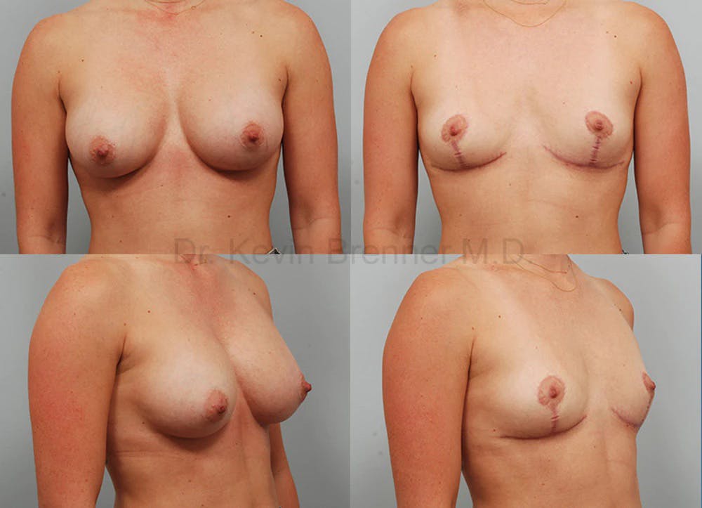 Breast Implant Removal Before & After Gallery - Patient 1482377 - Image 1