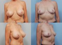 Breast Implant Removal Before & After Gallery - Patient 16862636 - Image 1