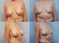 Breast Lift Before & After Gallery - Patient 408671 - Image 1