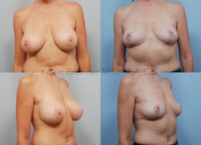 Breast Lift Before & After Gallery - Patient 408671 - Image 1