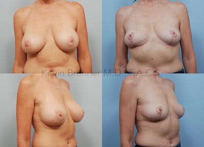 Breast Implant Removal Gallery - Patient 16862636 - Image 1