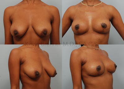 Breast Lift Gallery - Patient 26560689 - Image 1