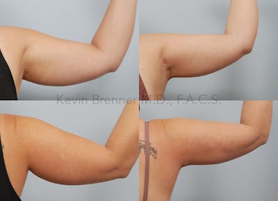 Brachioplasty Before & After Gallery - Patient 26560776 - Image 1