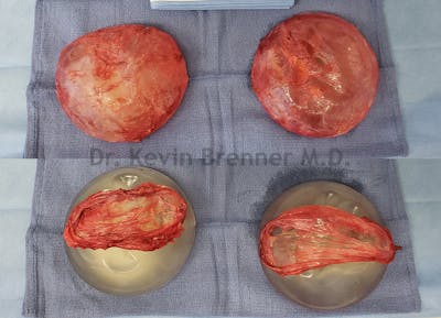 Breast Capsules Before & After Gallery - Patient 50307981 - Image 1