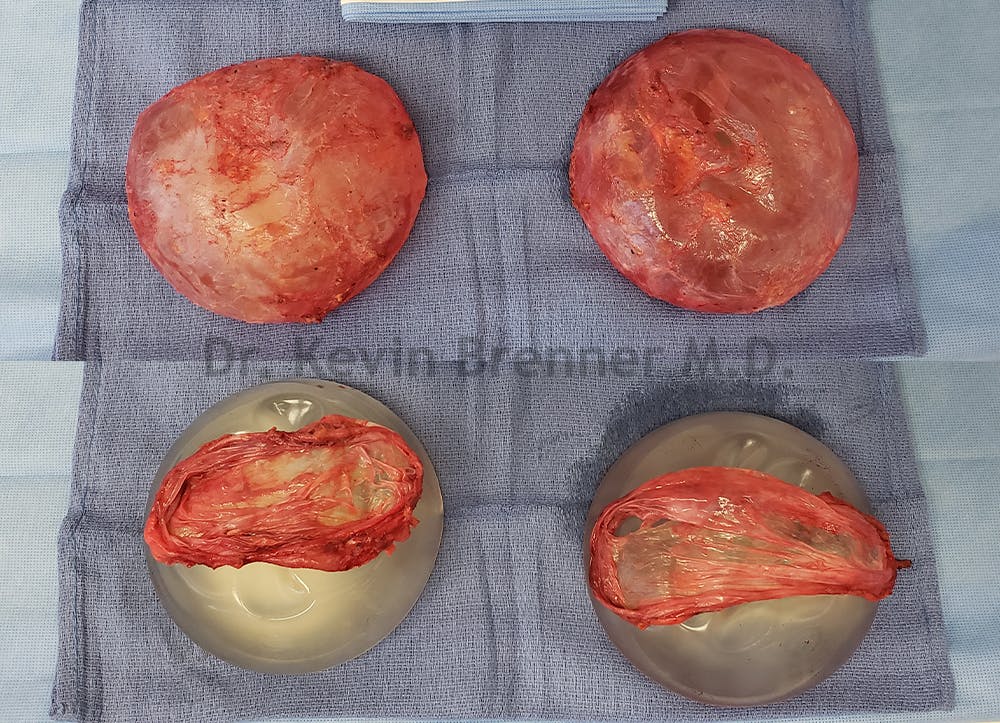 Breast Capsules Before & After Gallery - Patient 50307981 - Image 1