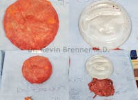 Breast Capsules Before & After Gallery - Patient 50307993 - Image 1