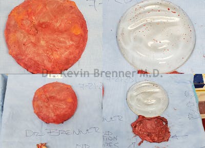 Breast Capsules Before & After Gallery - Patient 50307993 - Image 1