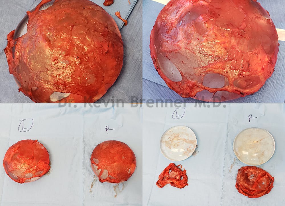 Breast Capsules Before & After Gallery - Patient 50307994 - Image 1