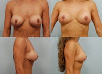 Breast Reconstruction Before & After Gallery - Patient 69075415 - Image 1