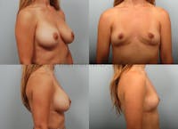 Breast Implant Removal Before & After Gallery - Patient 69075782 - Image 1