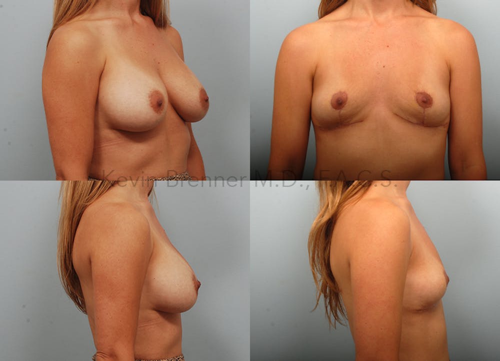 Breast Lift Before & After Gallery - Patient 289972 - Image 1