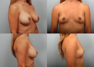 Breast Lift Before & After Gallery - Patient 289972 - Image 1
