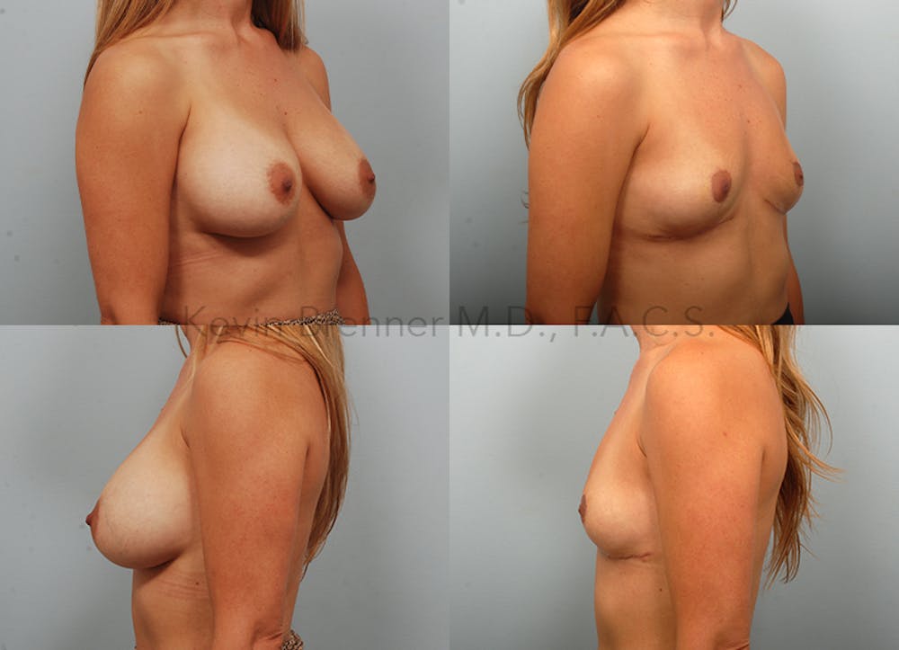 Breast Lift Before & After Gallery - Patient 289972 - Image 2