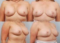 Breast Implant Removal Before & After Gallery - Patient 74784011 - Image 1