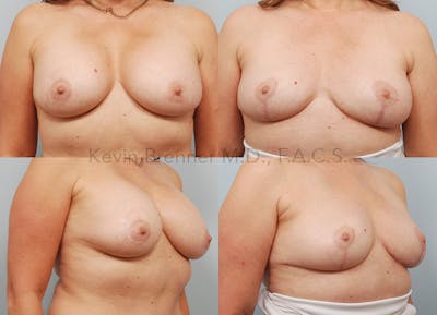 Breast Lift Before & After Gallery - Patient 468050 - Image 1