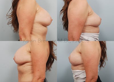 Breast Lift Before & After Gallery - Patient 468050 - Image 2