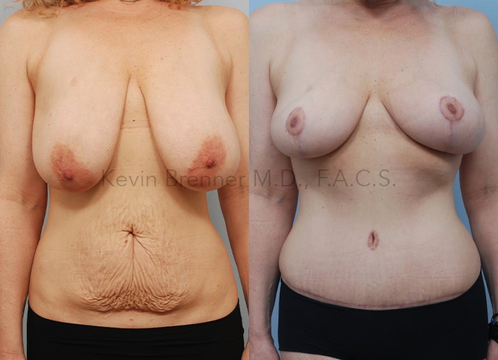 Mommy Makeover Before & After Gallery - Patient 74784235 - Image 1