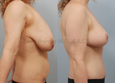 Mommy Makeover Before & After Gallery - Patient 74784235 - Image 2