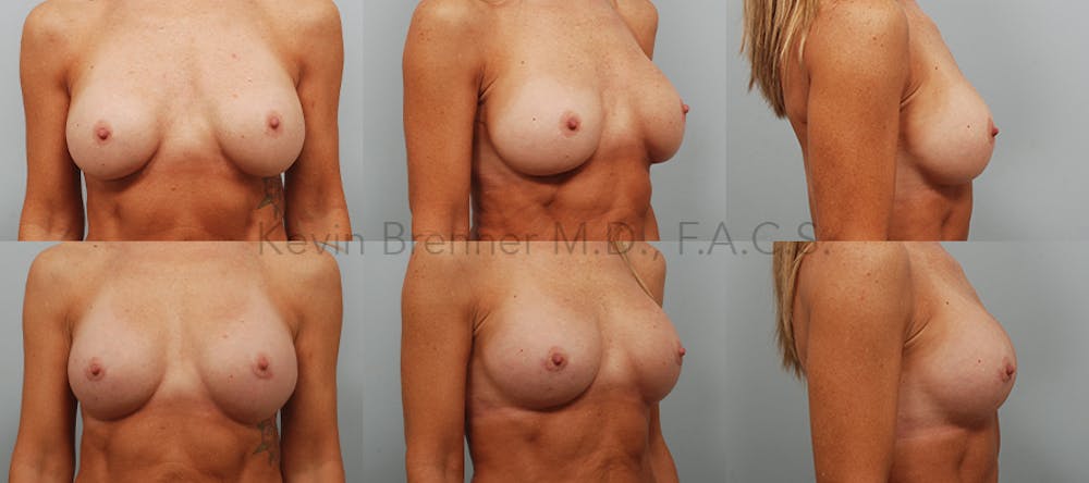 Breast Revision Surgery Before & After Gallery - Patient 96360109 - Image 1