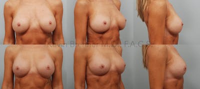 Breast Revision Surgery Before & After Gallery - Patient 96360109 - Image 1